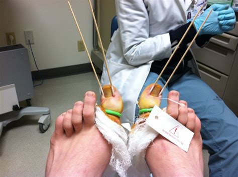 Ingrown toenail surgery. : r/WTF