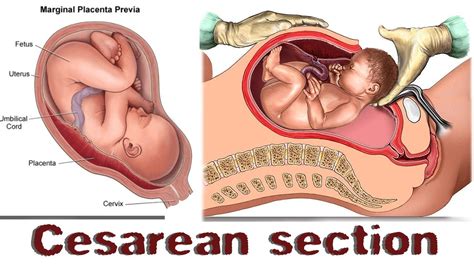 C-SECTION (Cesarean Delivery) | CESAREAN SECTION DELIVERY - YouTube