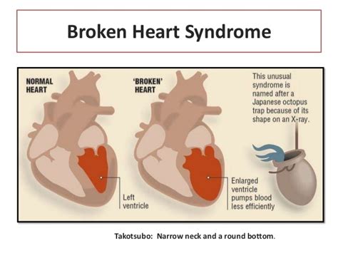 Broken heart syndrome,what to know?