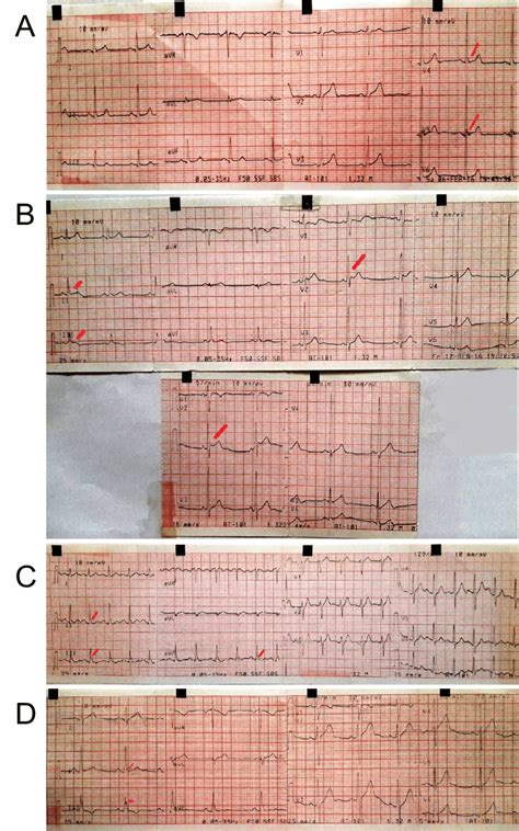 (a-d) Early repolarization syndrome. | Download Scientific Diagram