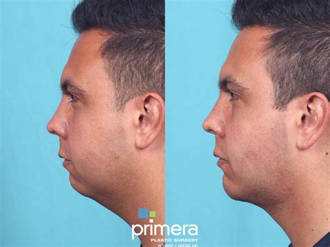 Buccal fat/ Cheek fat removal & Chin Implant in Orlando Florida