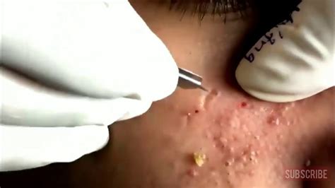 Pimple Popping Videos 2024 Blackheads Popping - Sadie Collette