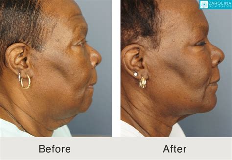 Neck Lift Recovery Day by Day - Carolina Facial Plastics