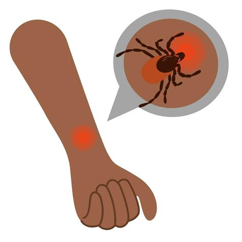 The human hand with the tick bite. Tick bite hand.Tick bite. Healthcare ...