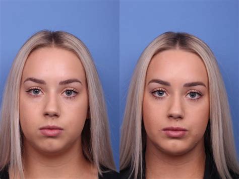 Chin Implant Before and After Photo Gallery | Scottsdale, AZ | Hobgood Facial Plastic Surgery ...