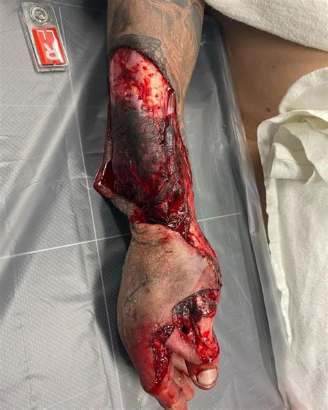 A severe forearm injury characterized by degloving and a broken wrist, resulting from an ...