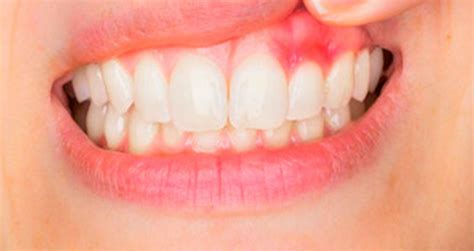 What Is Gum Disease?