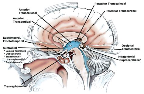 Midsagittal View of the Head Showing the Operative Approaches to the Third Ventricle ...