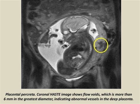 Presentation1, radiological imaging of placenta accreta.