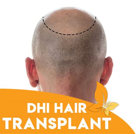 DHI Hair Transplant | Bariest