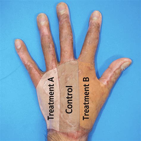 the dorsum of the hand was divided into three areas: radial, central,... | Download Scientific ...