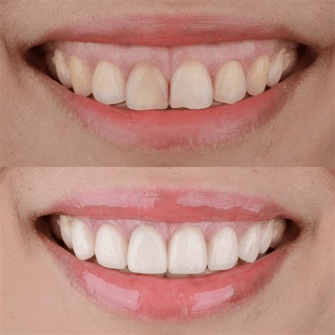 How to fix a gummy smile (excessive gingival display)?