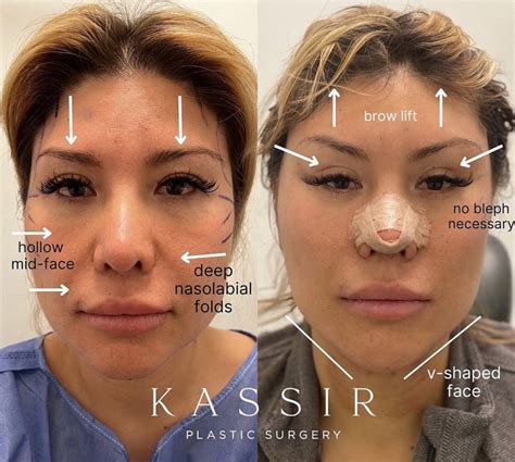 Cat Eye Facelift and Midface Lift in New York — Kassir Plastic Surgery in NY and NJ