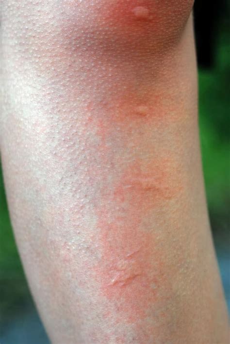 Mosquito Bites Allergy Treatment
