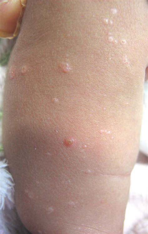 Cutaneous Presentation of Langerhans Cell Histiocytosis in a Neonate | Consultant360