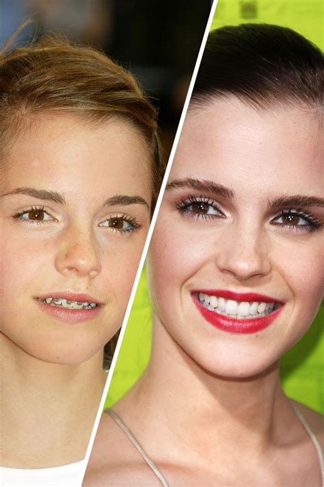 Famous Faces with Braces | Celebrities with braces, Perfect smile ...