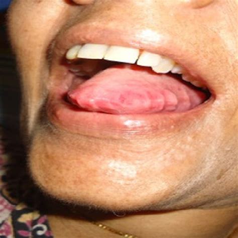 Pre-treatment PIP joint swelling Fig. 2: Macroglossia | Download ...