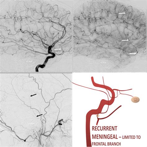 Subdural Hematoma Embolization | neuroangio.org