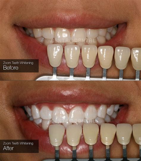 zoom teeth whitening before after photos