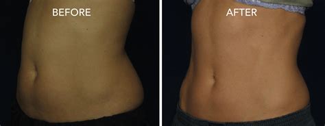 Coolsculpting: Before/After Photos | DermMedica