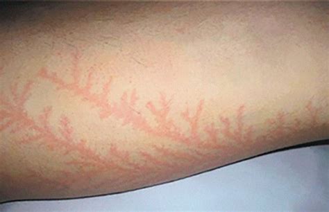 Lichtenberg Scars — Nature’s Tattoo You Don’t Want To Have | Bored Panda