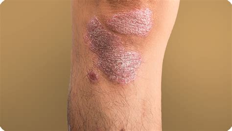 Psoriasis Armpit Rash