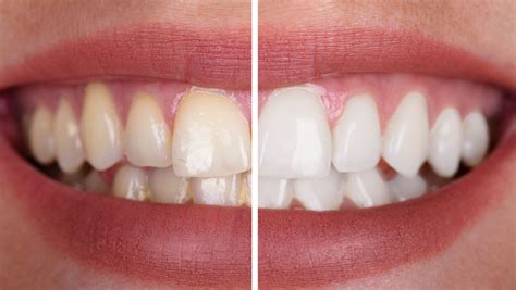 Deep Teeth Cleaning: Before and After - Dental Health Society