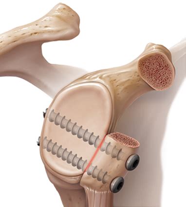 Latarjet for shoulder instability | Orthopaedic shoulder surgeon Perth