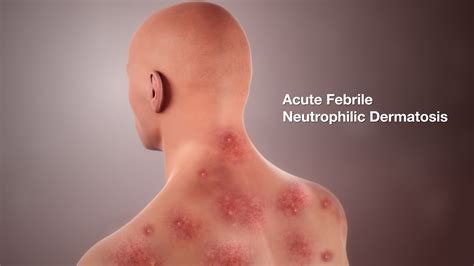 Acute Febrile Neutrophilic Dermatosis Shown Using Medical Animation Still