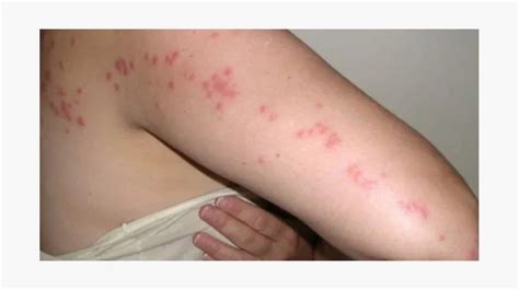 Bites and Stings: Pictures, Causes, and Symptoms