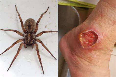 The worst spider bite pictures including the Brown Recluse and Black Widow - Mirror Online