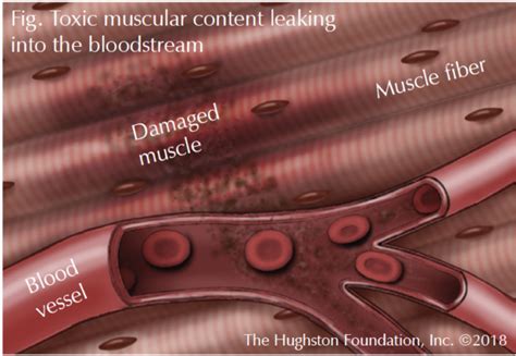 Rhabdomyolysis Arm