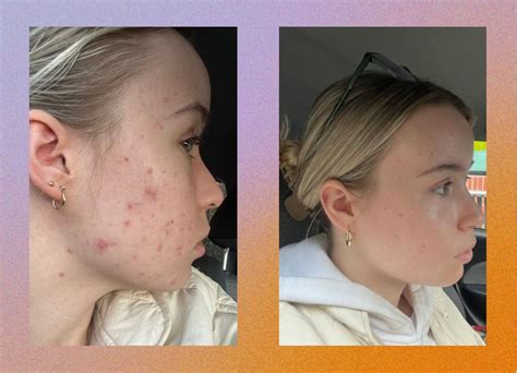 I cut out skincare for two months to see if it would fix my skin