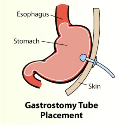 Gastrostomy Tube