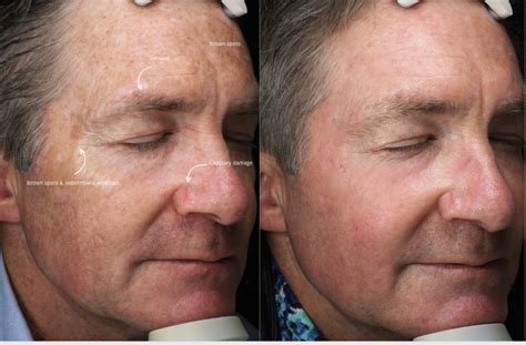 Sun Damage Restoration — Northern Sydney Dermatology & Laser | Sydney ...