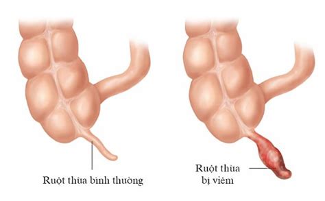 Các biến chứng của viêm ruột thừa có thể gặp