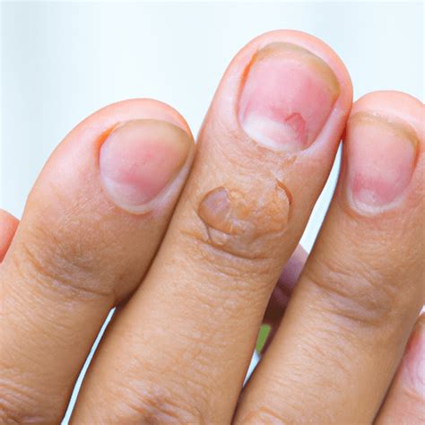 Hangnail infection | Small Analyst 2024