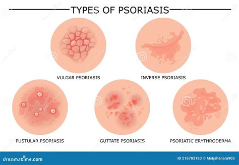 Psoriasis Types. Skin Hives, Derma Diseases. Closeup Medical Vector Illustration | CartoonDealer ...