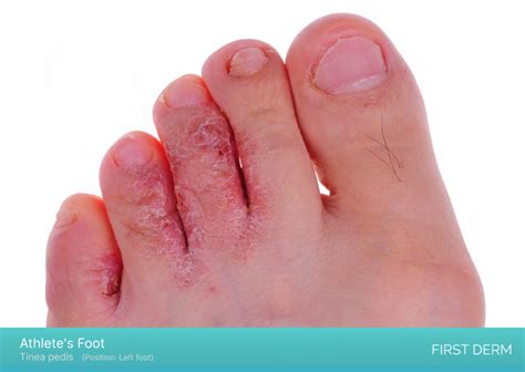 Discover 105+ itchy heel of foot - jtcvietnam.edu.vn