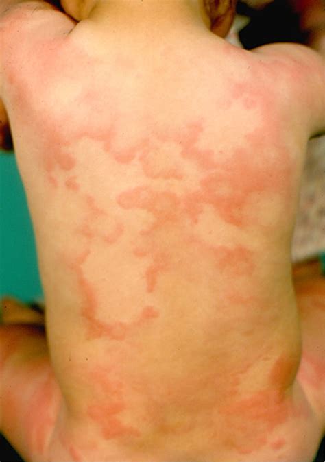 Erythema Infectiosum Lacy Rash