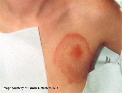 STARI (Southern Tick-Associated Rash Illness) - Lyme Disease Association