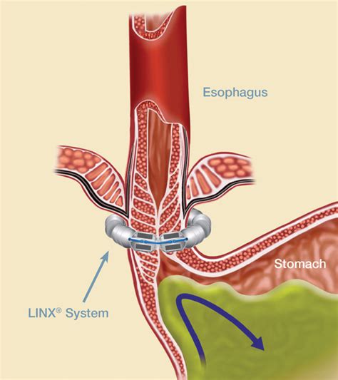 LINX Magnetic System for Acid Reflux Patients | West Chester Hospital