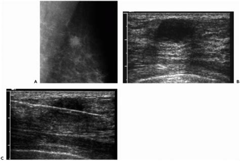 Impact of Percutaneous Image-Guided Core Biopsy on the Clinical ...