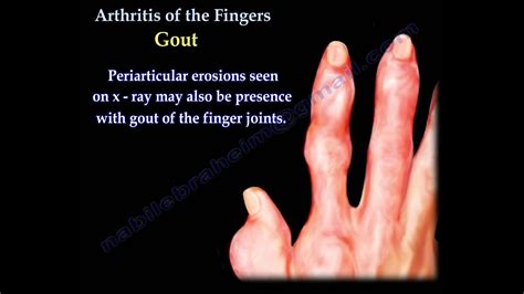 Arthritis Of The Fingers types and patterns - Everything You Need To Know - Dr. Nabil Ebraheim ...