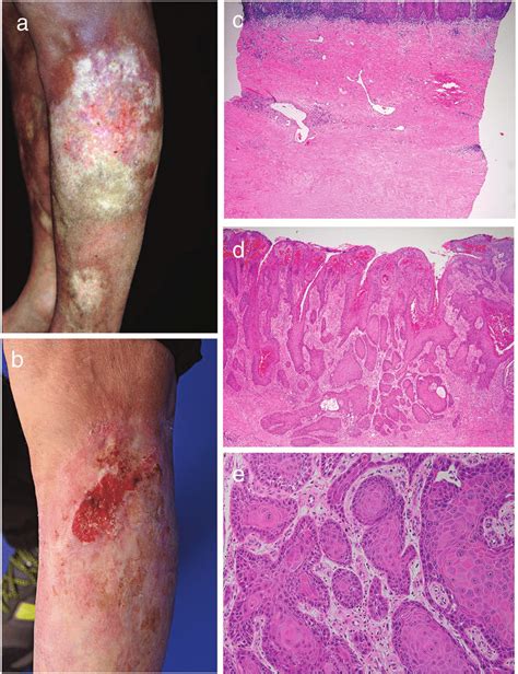 How Is Cutaneous Squamous Cell Carcinoma Treated Chri - vrogue.co