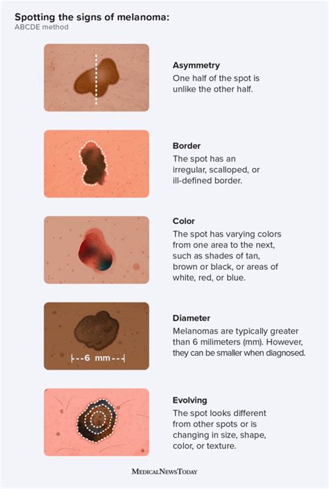 The ABCDE of skin cancer