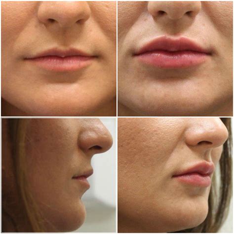 Makeup Wrinkles, Cover Wrinkles, Dermal Fillers, Lip Fillers, Facial ...