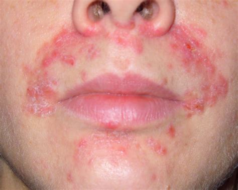 Perioral dermatitis causes, symptoms, diagnosis & treatment