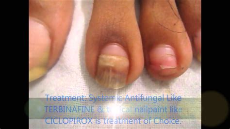 hand fungus treatment - pictures, photos