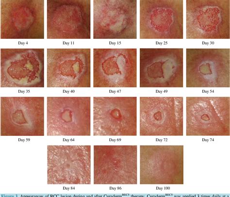 Basal Cell Skin Cancer Treatment